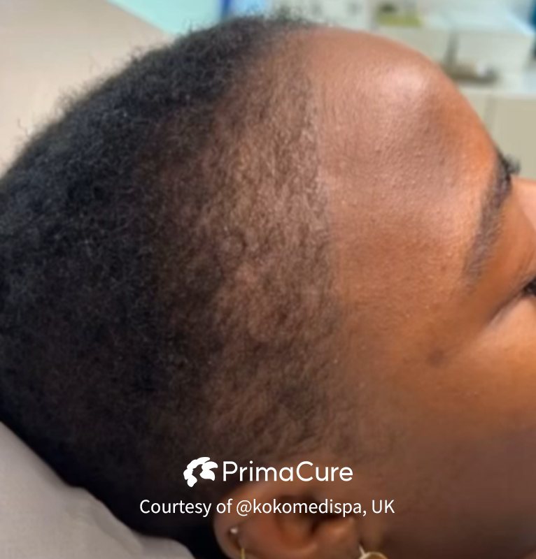 Dainfern Aesthetics - Exosome Hair Needling