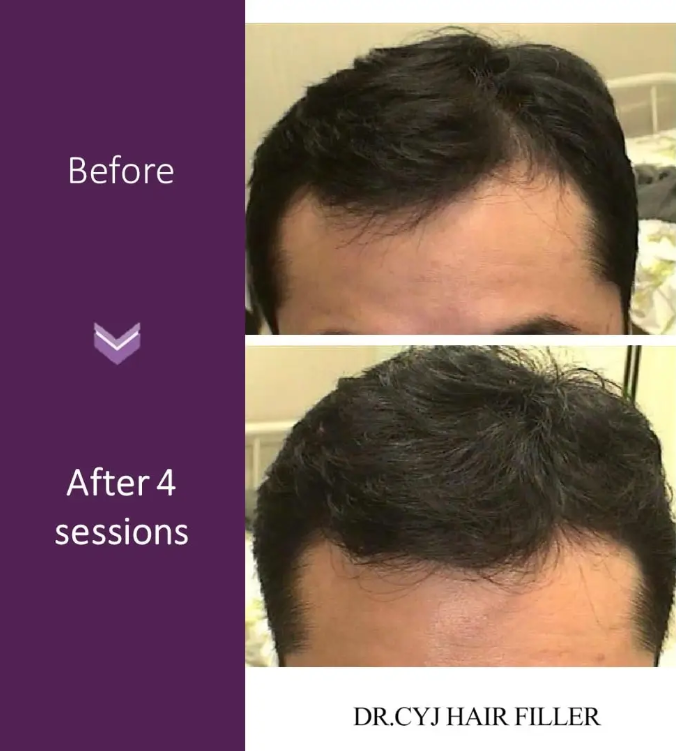 Dainfern Aesthetics - PA Hair Filler - 4 Session Package
