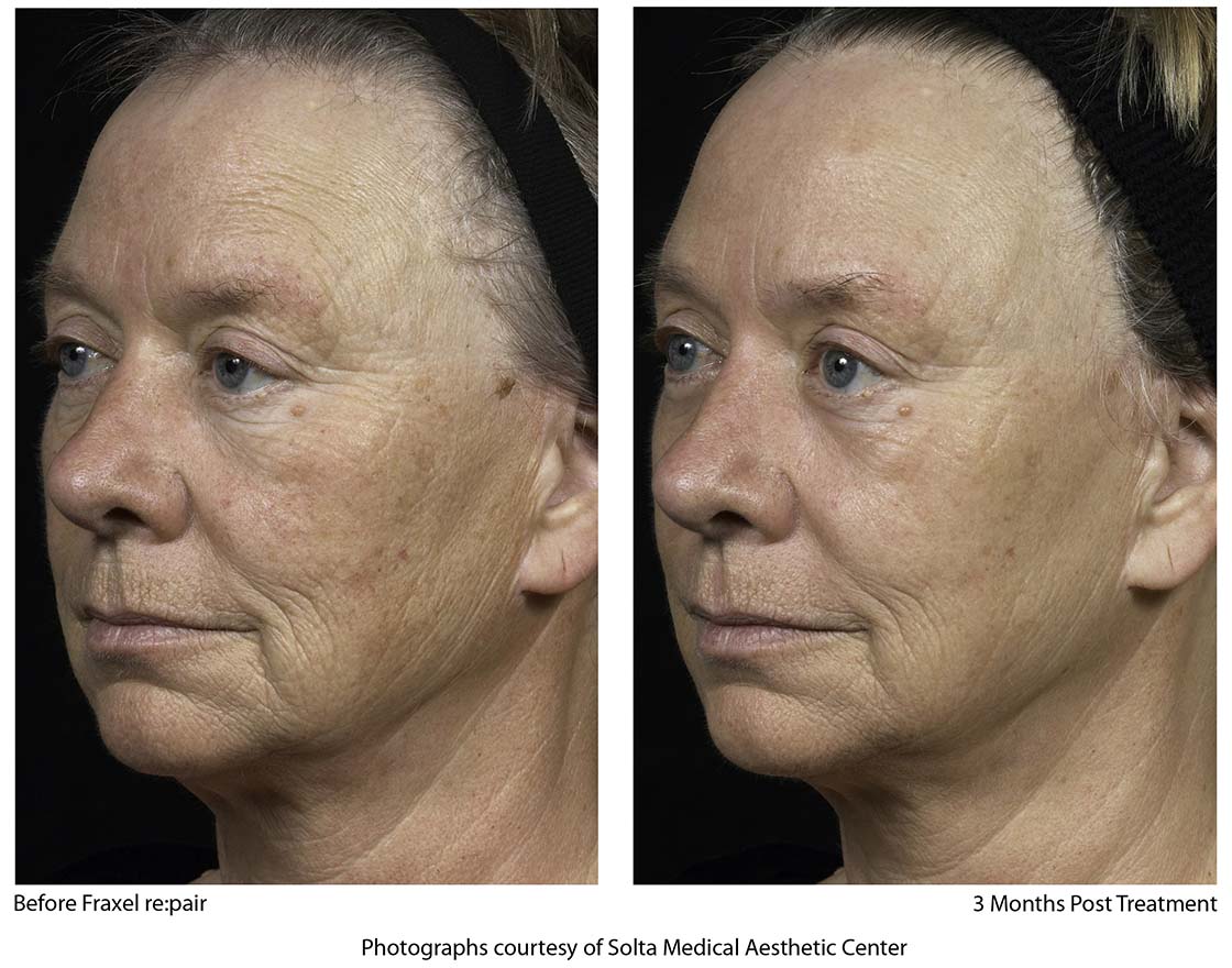 Fraxel® Dual Laser Resurfacing
