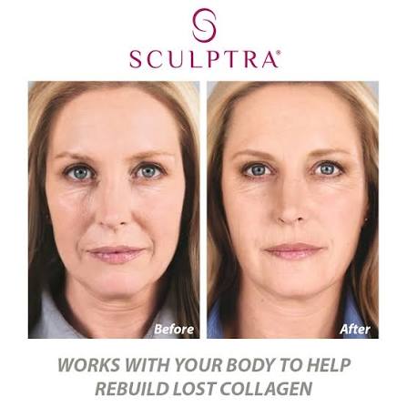 Bio Stimulators | Sculptra