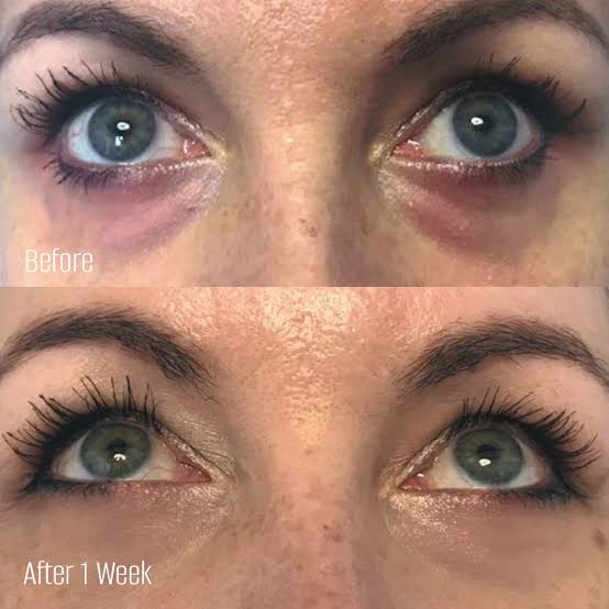 Injectable Skin Booster - Sunekos