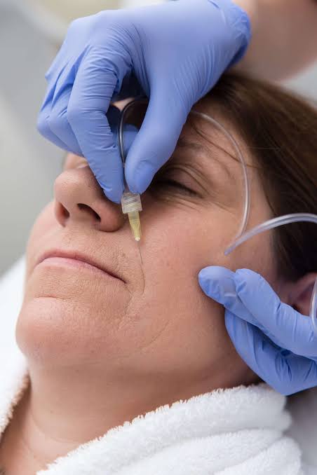 Dainfern Aesthetics - Carboxy Therapy