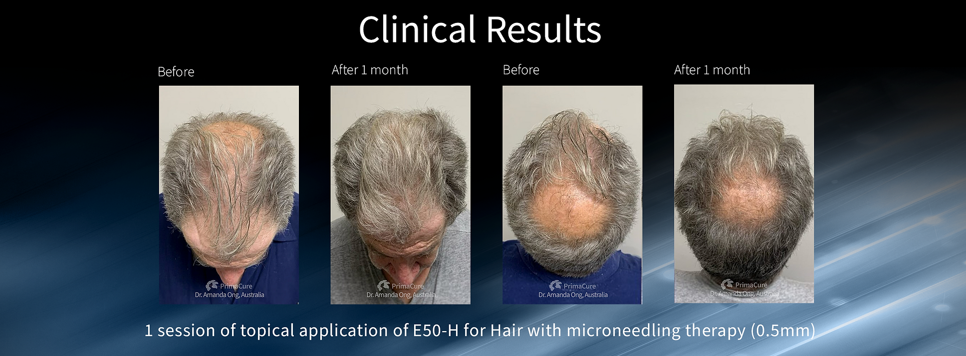 Dainfern Aesthetics - Exosome Hair Needling