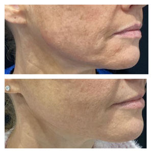 Bio Stimulators | HarmonyCA