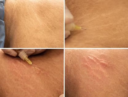 Dainfern Aesthetics - Carboxy Therapy