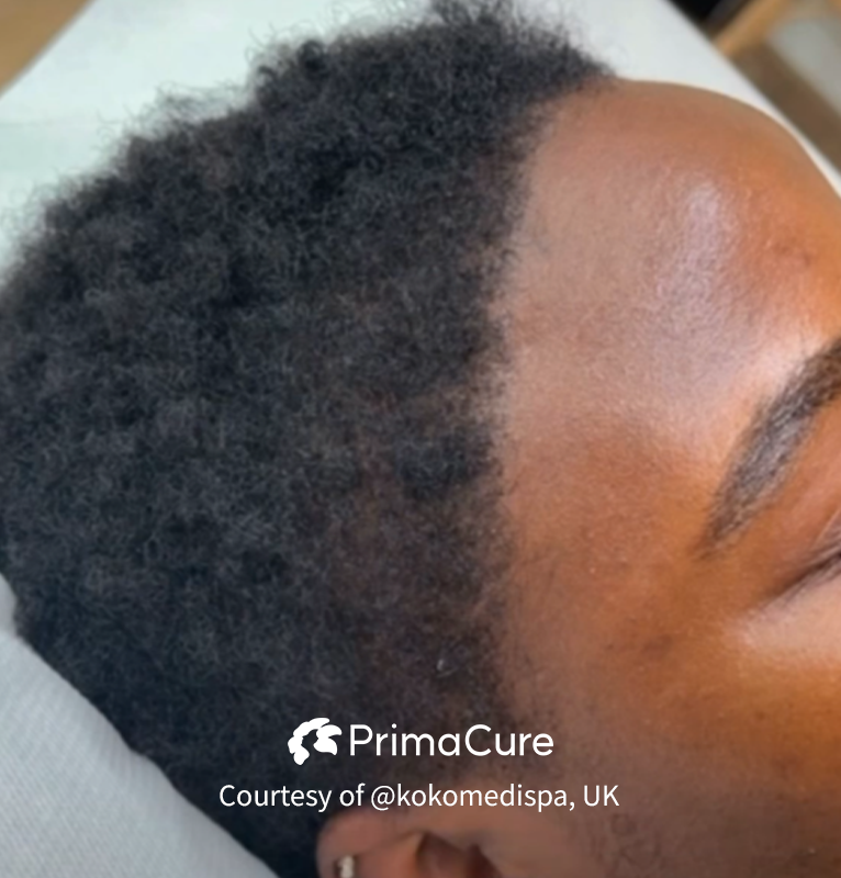 Dainfern Aesthetics - Exosome Hair Needling