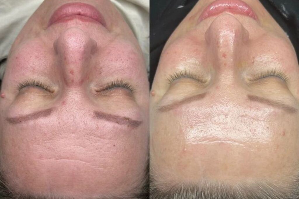 Skin Peel - Bio-RePeel