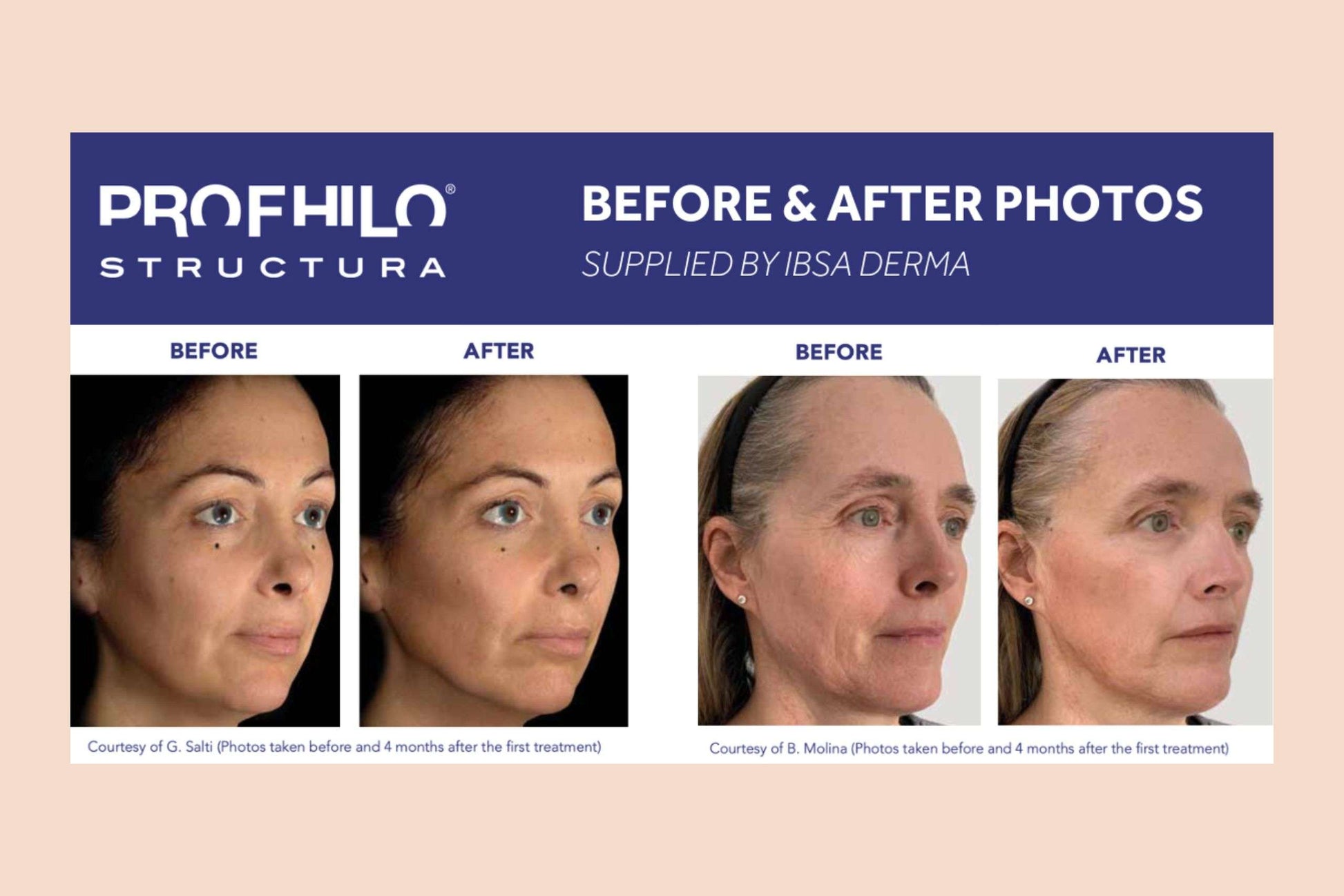 Bio Stimulators |PROFHILO® STRUCTURA