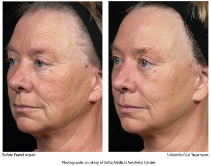 Fraxel® Dual Laser Resurfacing