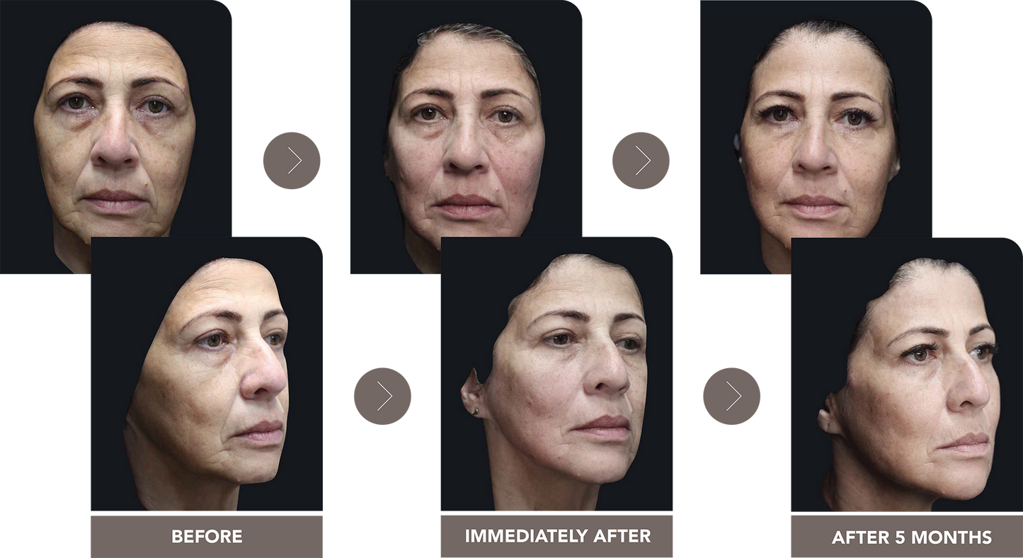 Bio Stimulators | HarmonyCA