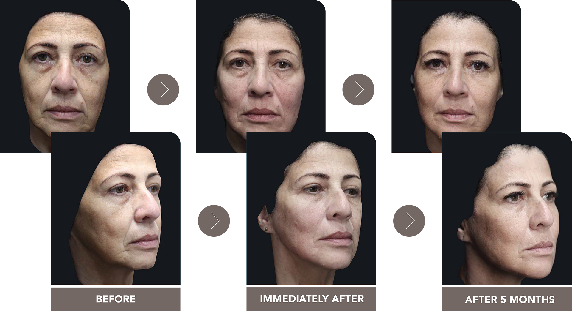 Bio Stimulators | HarmonyCA