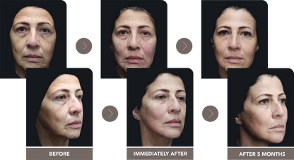 Bio Stimulators | HarmonyCA