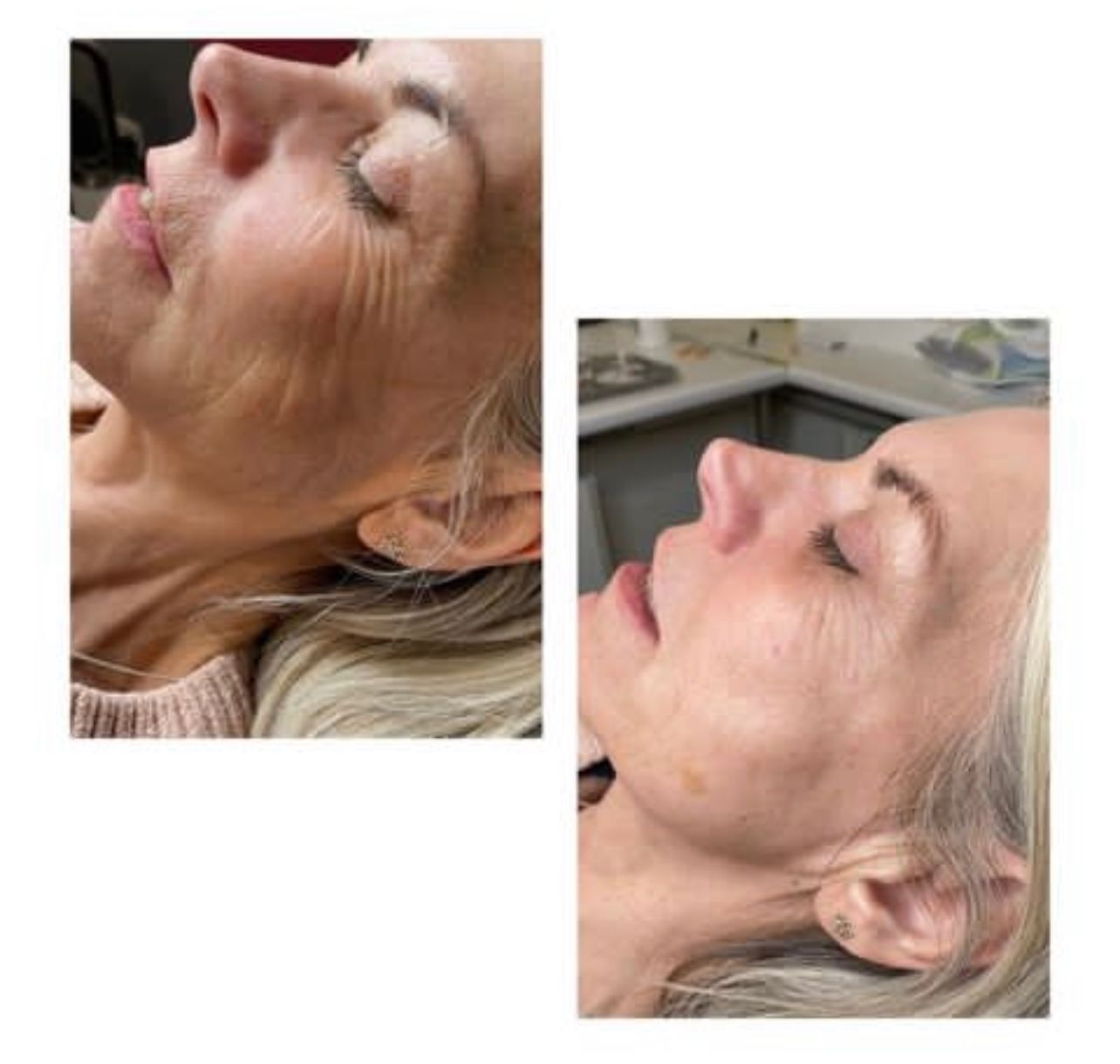 Injectable Skin Booster - Sunekos