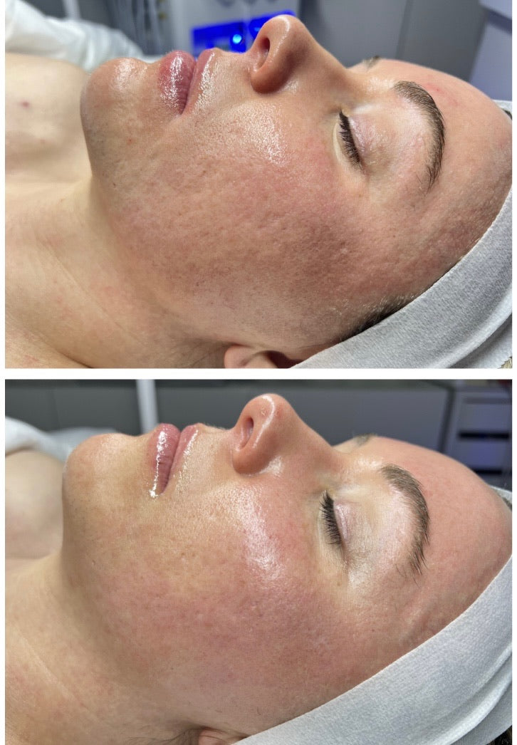 Skin Peel - Bio-RePeel