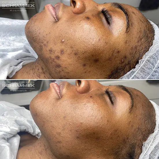 Peels – Dr Schrammek GREEN PEEL