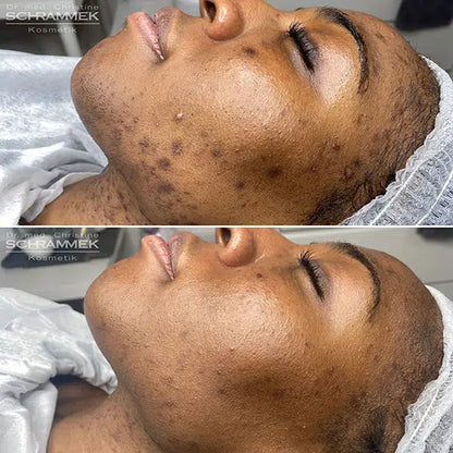 Peels – Dr Schrammek GREEN PEEL