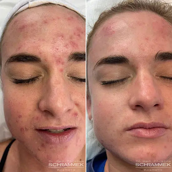 Peels – Dr Schrammek GREEN PEEL
