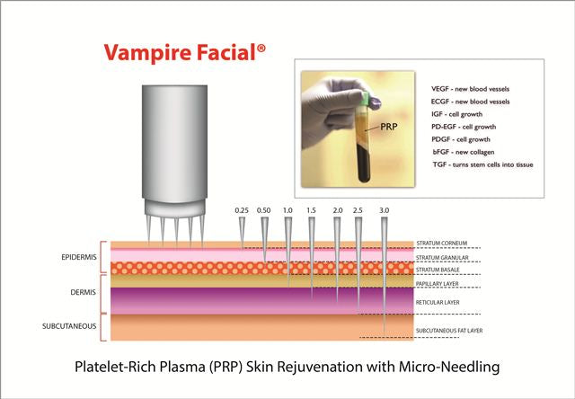 Dainfern Aesthetics - (Vampire Facial) Microneedling