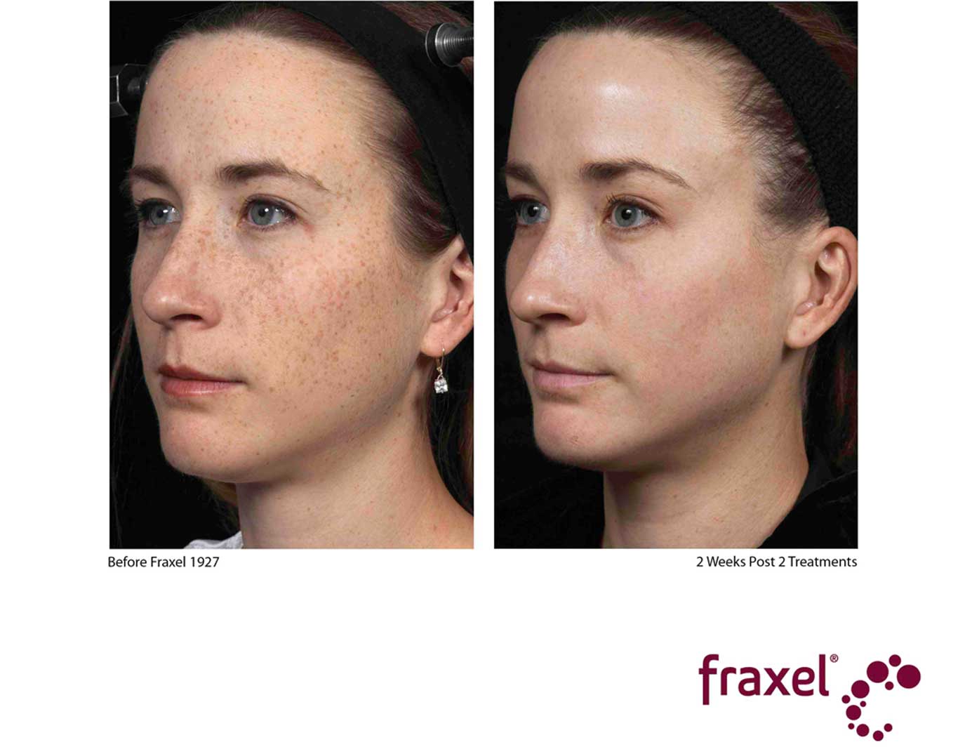 Fraxel® Dual Laser Resurfacing