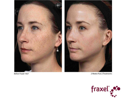 Fraxel® Dual Laser Resurfacing