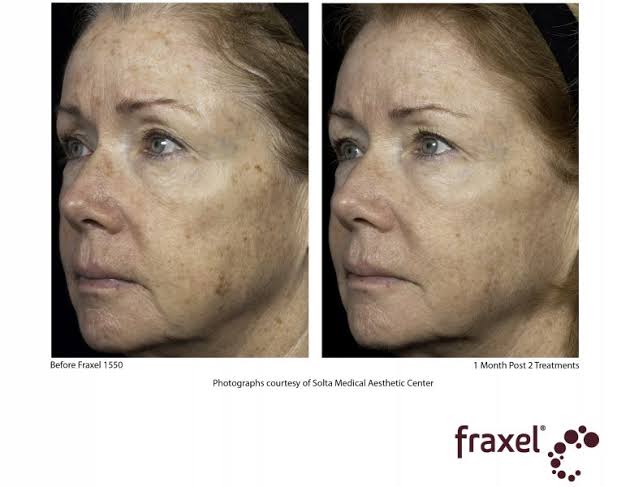 Fraxel® Dual Laser Resurfacing