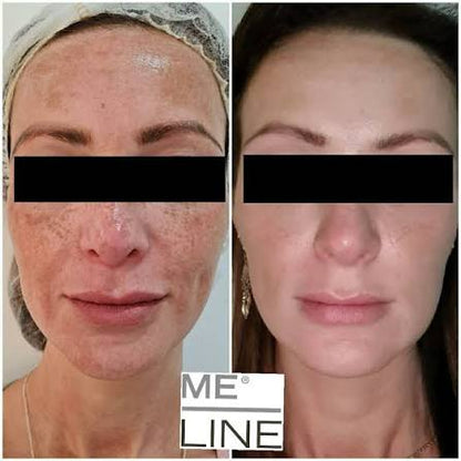 Dainfern Aesthetics - Meline Pigmentation Treatment