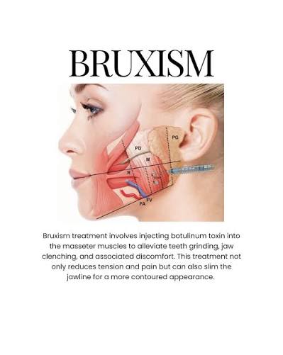 Botox/Dysport
