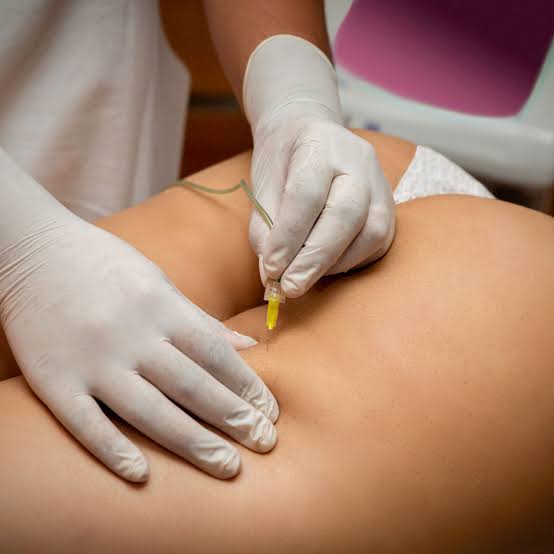 Dainfern Aesthetics - Carboxy Therapy