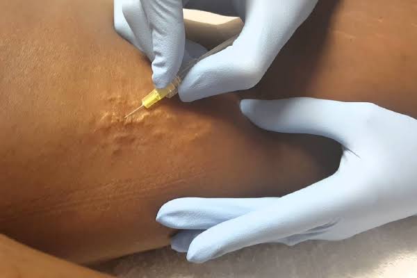 Dainfern Aesthetics - Carboxy Therapy