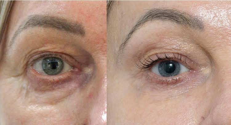 Tixel® Rejuvenation