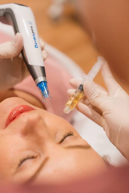 Dainfern Aesthetics - (Vampire Facial) Microneedling