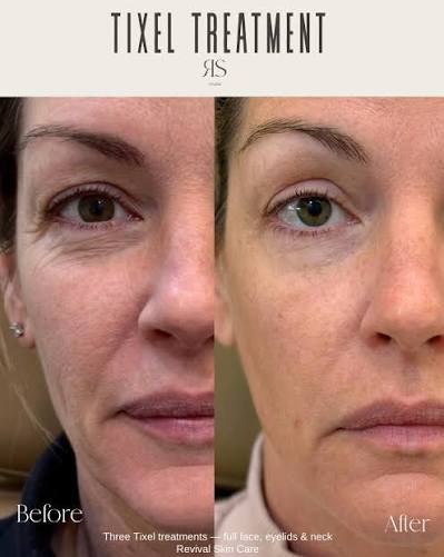 Tixel® Rejuvenation
