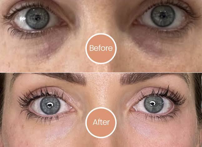 Injectable Skin Booster - Sunekos