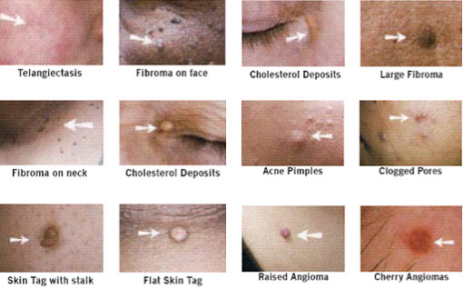 Dainfern Aesthetics - Lamprobe Skin Lesion Removal